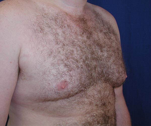 Real patient #1 Gynecomastia surgery before photo