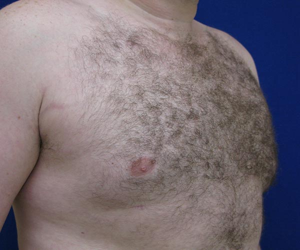 Real patient #1 Gynecomastia surgery after photo