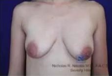 Real Patient - Breast Lift Before