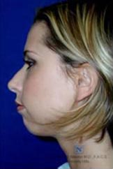 Real Patient - Cheek and Chin Augmentation After