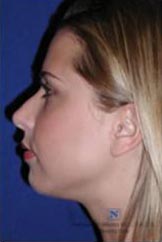 Real Patient - Cheek and Chin Augmentation Before
