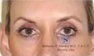 Eye Lift (Blepharoplasty)
