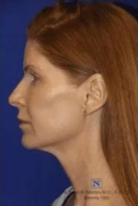 Real Patient - Neck Lift Before