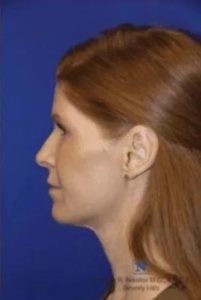 Real Patient - Neck Lift After