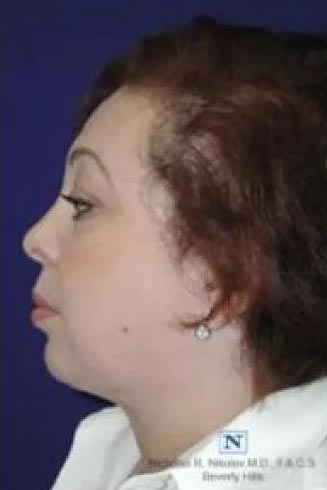Modified Neck Lift with RFAL and Facetite