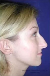 Real Patient - Rhinoplasty Before