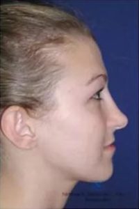 Real Patient - Rhinoplasty After