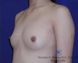 Breast Augmentation (Mammoplasty)