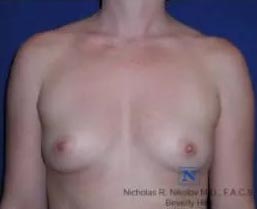 Breast Augmentation (Mammoplasty)
