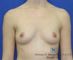 Real Patient - Breast Augmentation Before