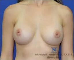 Real Patient - Breast Augmentation After