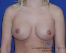 Breast Revision Surgery (Capsulectomy)
