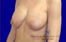 Breast Revision Surgery (Capsulectomy)