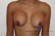 Real Patient - Breast Revision Surgery Before