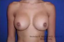 Real Patient - Breast Revision Surgery After