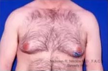 Real Patient - Male Breast Reduction Before