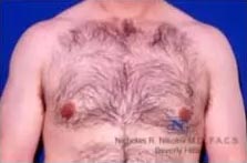 Real Patient - Male Breast Reduction After