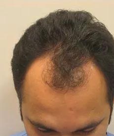 Real Patient - Neograft Fue Hair Transplant Before