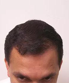 Real Patient - Neograft Fue Hair Transplant After