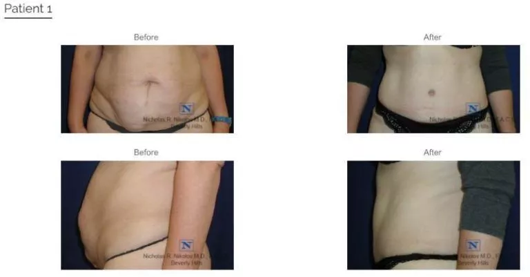Real patient before and after photos from Dr. Nikolov