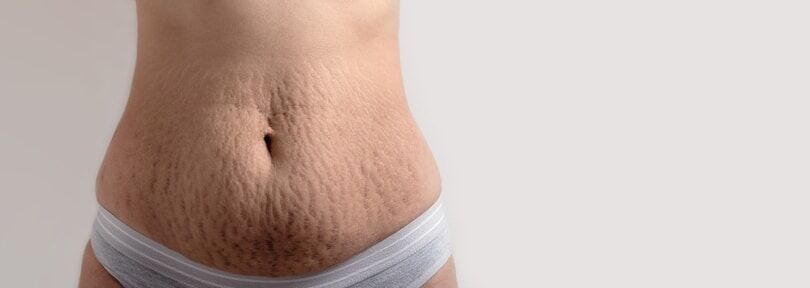Photo of a woman after Liposuction