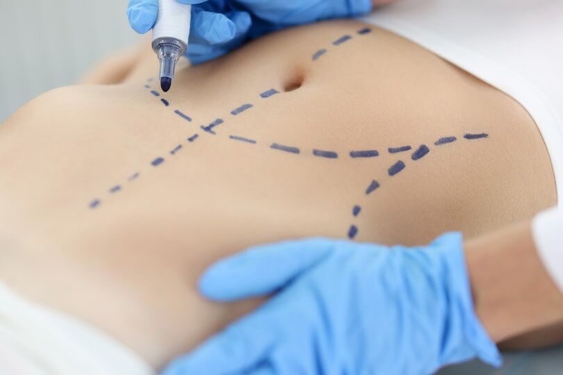 Woman getting lipo markings prior to surgery