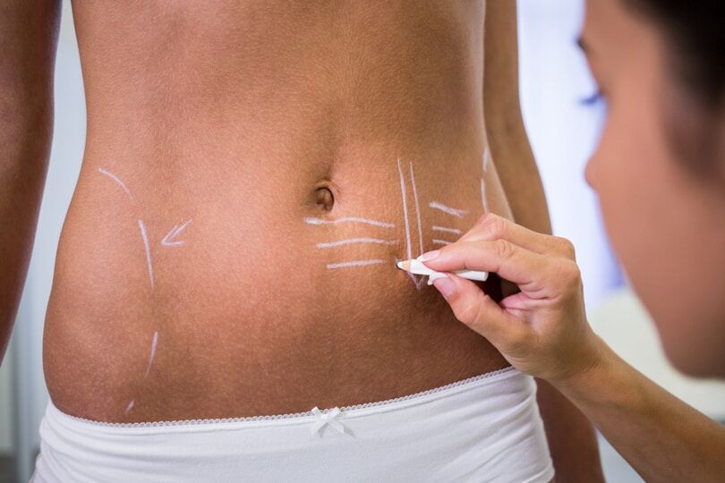 Photo of a woman having surgical notes on stomach