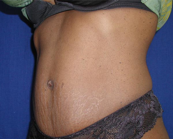 Real Patient - Tummy Tuck After