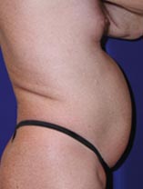 Real Patient - Liposuction Before