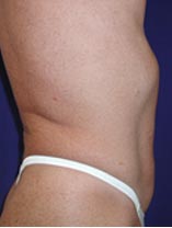 Real Patient - Liposuction After