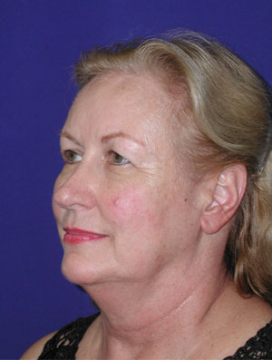 Real Patient - Facelift Before