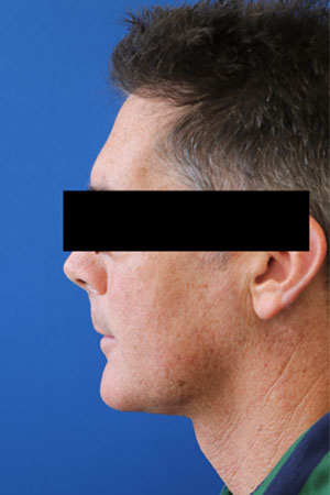Modified Neck Lift with RFAL and Facetite