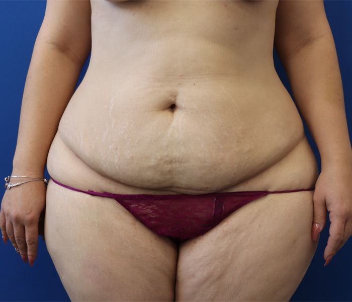 Real patient #2 Tummy Tuck procedure before photo