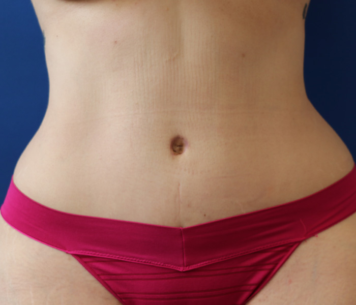 Real patient #2 Tummy Tuck procedure after photo