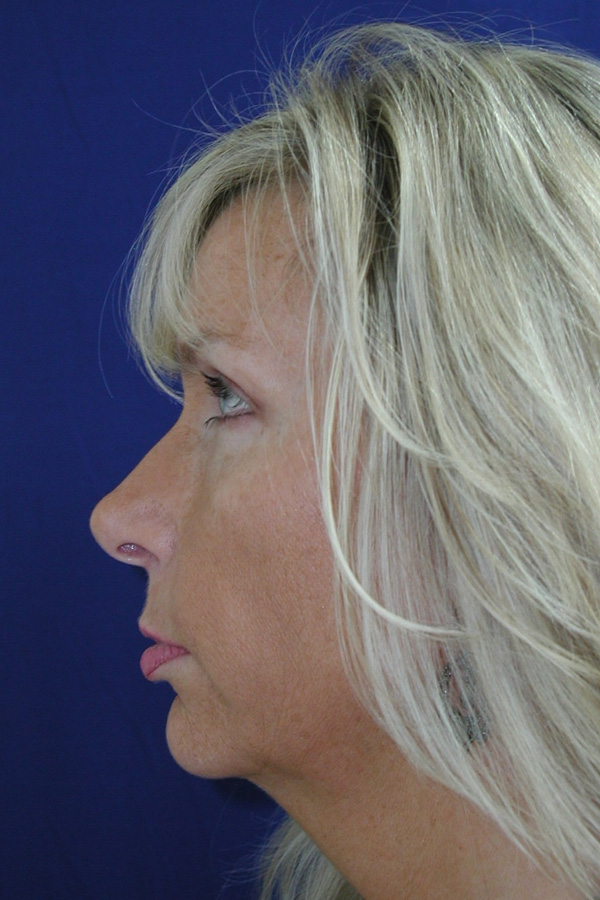 Rhinoplasty