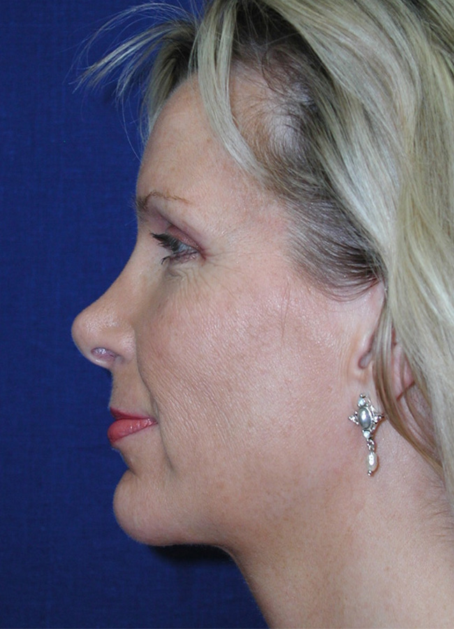 Modified Neck Lift