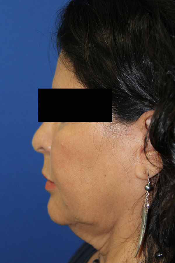 Rhinoplasty