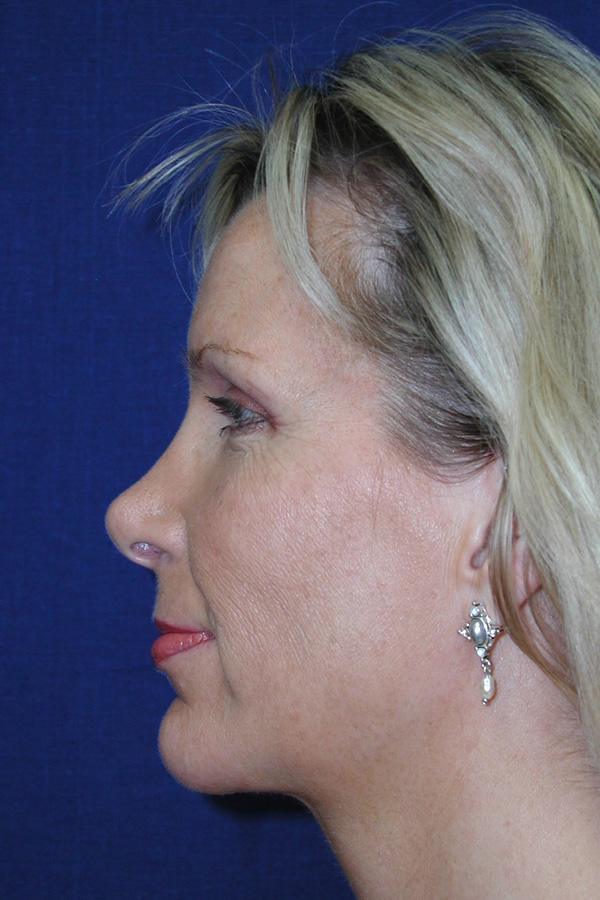 Rhinoplasty