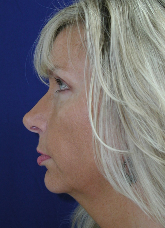 Modified Neck Lift