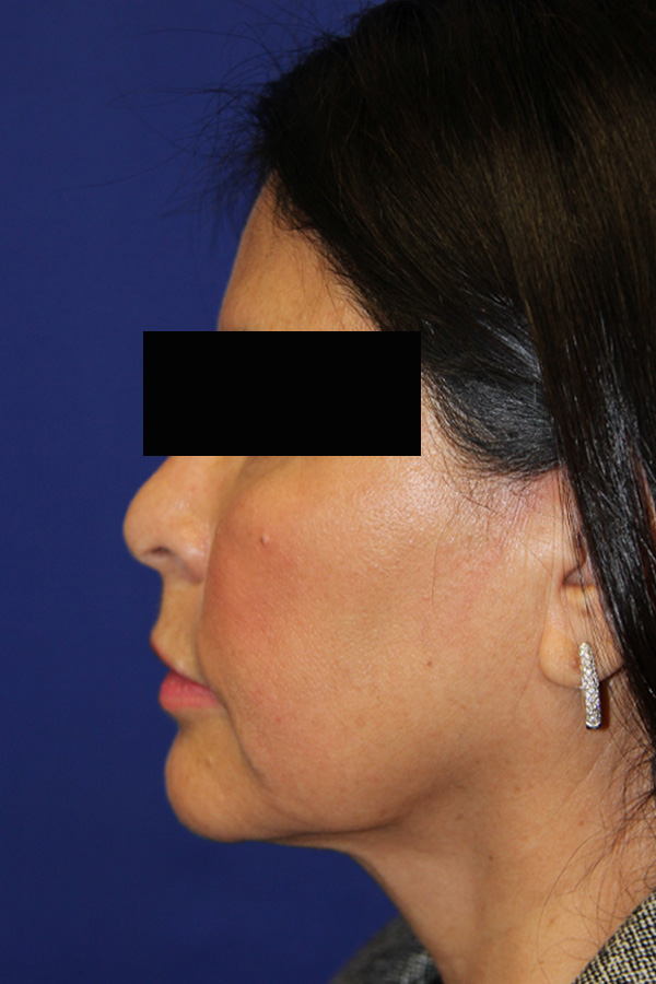 Rhinoplasty