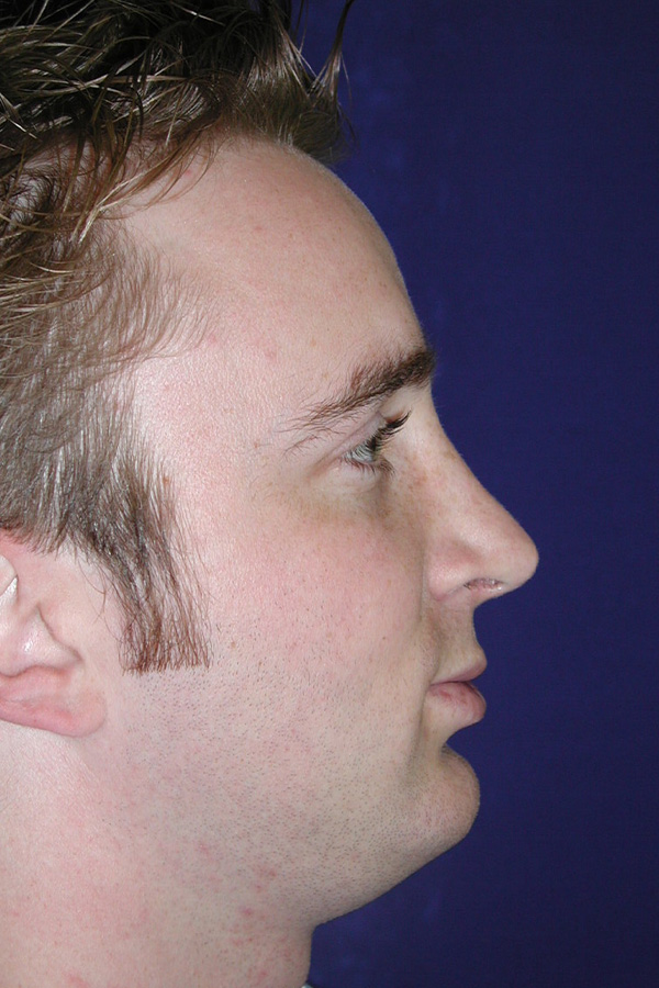 Real patient #2 Rhinoplasty procedure after photo