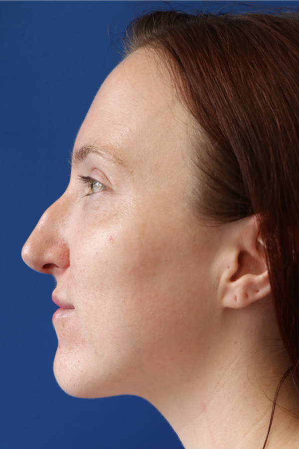 Rhinoplasty