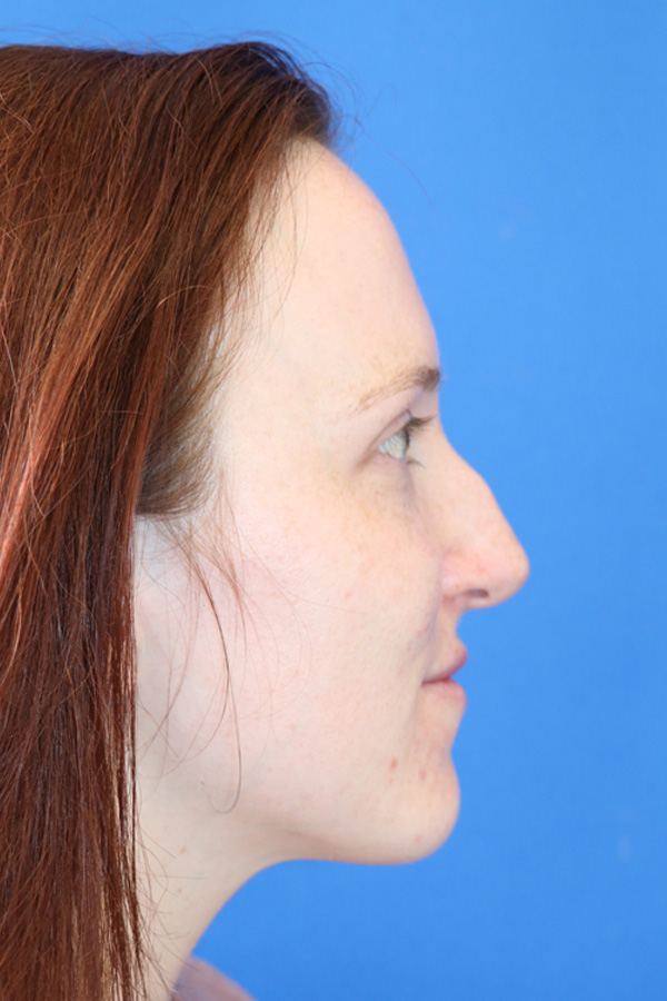 Rhinoplasty