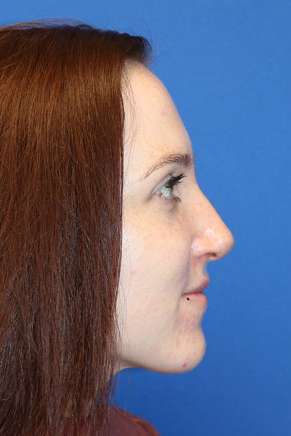 Rhinoplasty