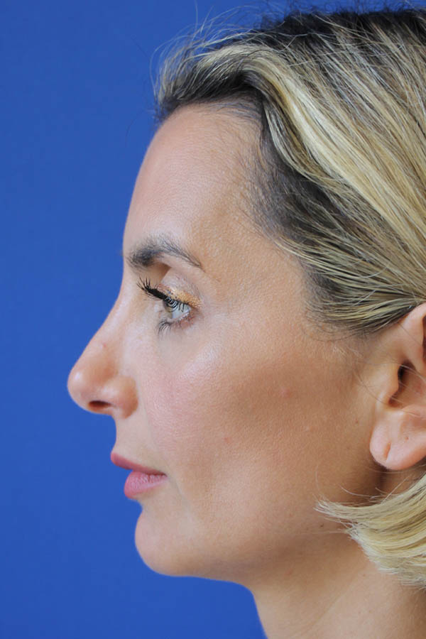 Rhinoplasty