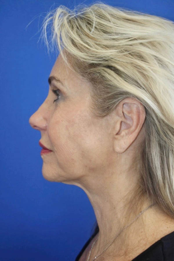 Facelift (Rhytidectomy)